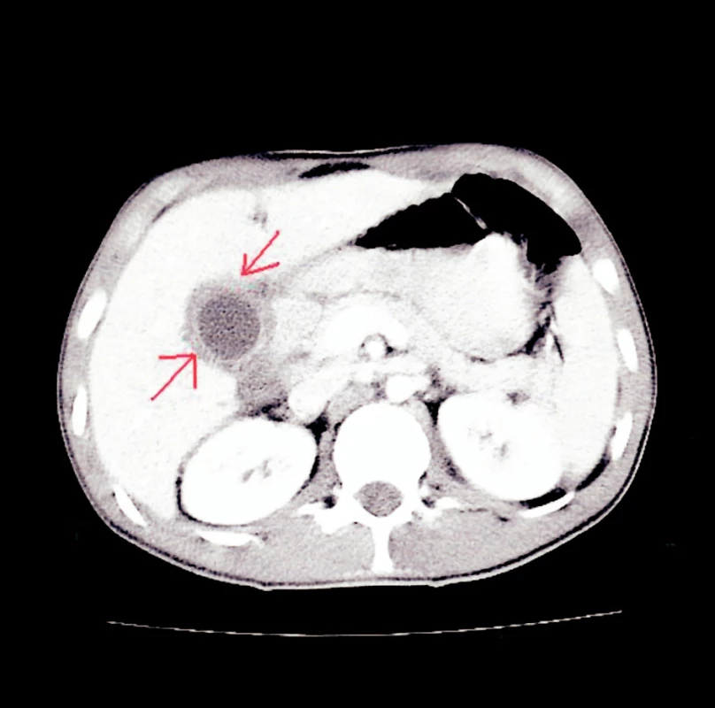 CT snímek – obraz cholecystitidy a pericholecysticidy s normálním obrazem v oblasti duodena
Fig. 6. CT view – Cholecystitis and pericholecystitis with a normal picture in the duodenal region