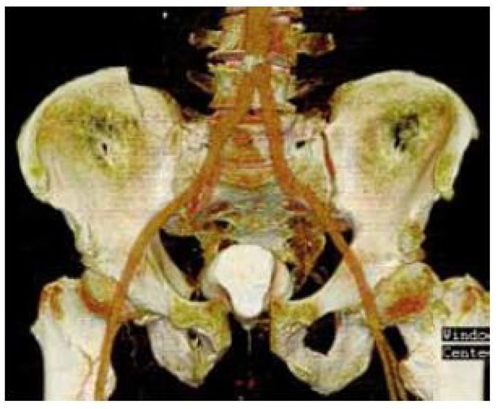 CT pánve (koronární řez v 3D zobrazení) – diastáza symfýzy s patrným prolapsem močového měchýře
Fig. 7. CT of pelvis (coronal section in 3D) – picture shows diastasis symphysis with prolaps of the urinary bladder