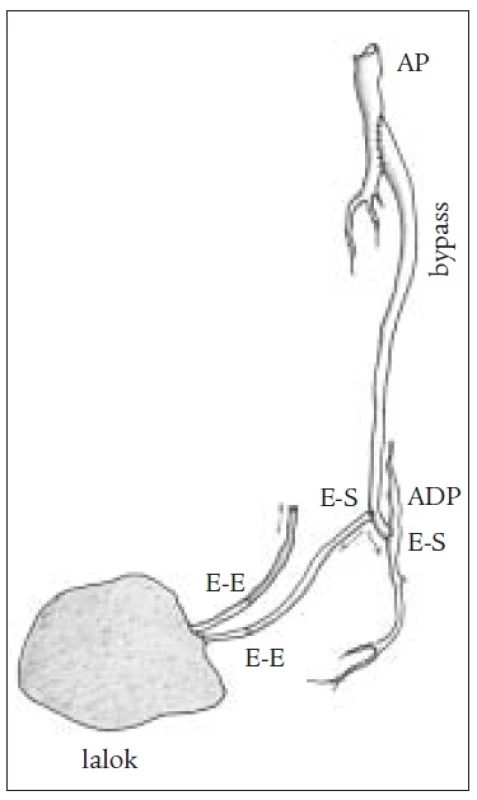 Schéma kombinovaného výkonu s end to side anastomózou.