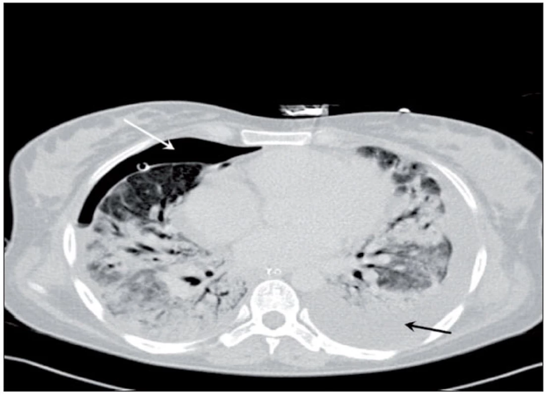 CT plic – extenzivní parenchymové konsolidace s negativním bronchogramem a ventrálním pneumotoraxem vpravo (bílá šipka) 
Pneumotorax přetrvával i přes správnou polohu hrudního drénu. Je patrný také hrudní výpotek vlevo před drenáží (tmavá šipka).