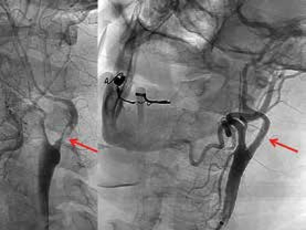 Vlevo je stav před intervencí: šipka ukazuje na exulcerovanou kritickou stenózu s trombem na vnitřní karotidě těsně nad bifurkací. Vpravo šipka ukazuje totéž místo po implantaci stentu.