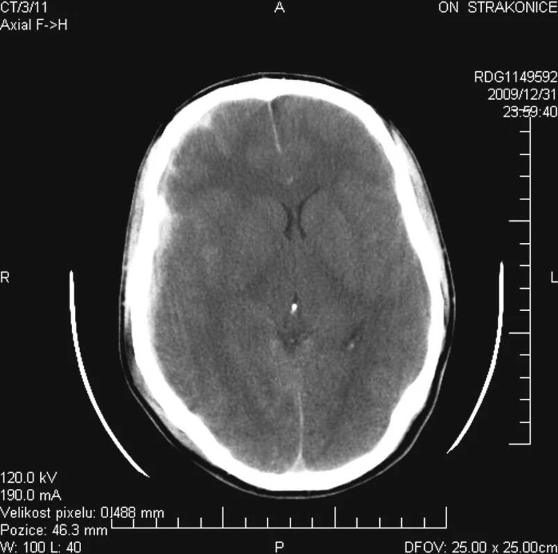 Iniciální CT s nálezem akutního subdurální hematomu nad pravou hemisférou mozku. Přetlak středočárových struktur byl 6 mm
Fig. 1. Baseline CT detecting acute subdural hematoma over the right cerebral hemisphere with a 6 mm shift of cerebral midline structures