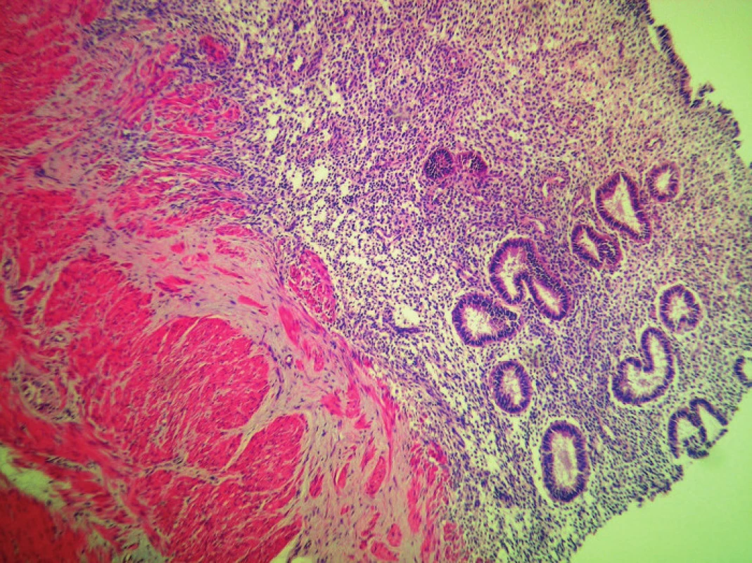 Stena hrubého čreva, na seróznom povrchu a v muscularis propria so štruktúrami endometriózy, HE 40x
Fig. 3: Intestinal tissue infiltrated with endometrial cells and stroma, HE 40x