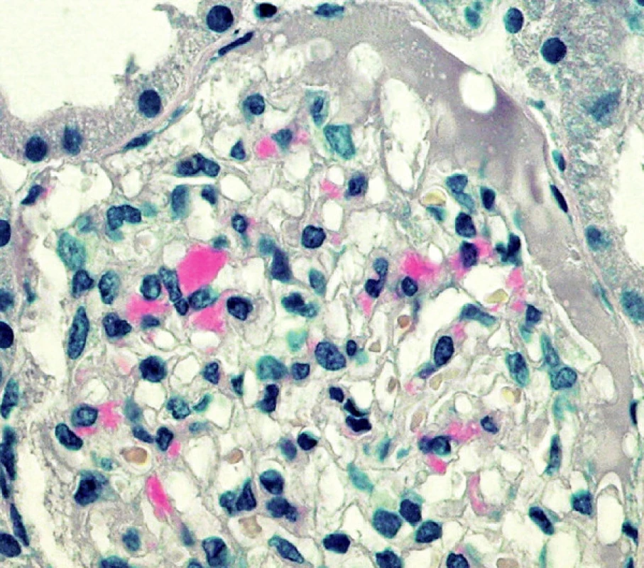Drobná ložisková depozita amyloidu v glomerulu (barvení Saturnovou červení; objektiv 40krát)