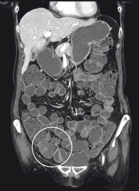 CT enterografie prokazující krátkou stenózu terminálního ilea s mírnou prestenotickou dilatací ilea.