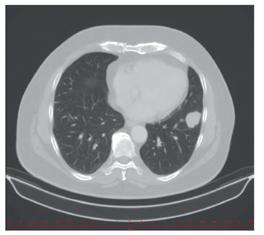 Metastáza v levém plicním poli
v únoru 2017 – RTG klinika VFN