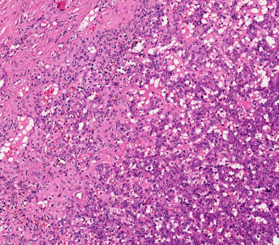 Nádor z juxtaglomerulárních buněk ledviny – sinusoidní kapiláry na periferii tumoru, HE, 400krát