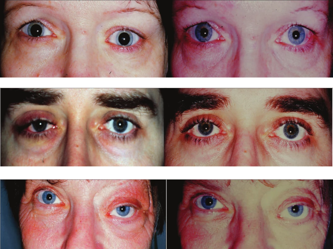 Klinický nález před stanovení histologické diagnózy (vpravo) a stav po zklidnění po zevní orbitotomii (vlevo) u pacientů se zánětlivým pseudotumorem slzné žlázy. Nahoře kazuistika č. 1, uprostřed kazuistika č. 2, dole kazuistika č. 3
