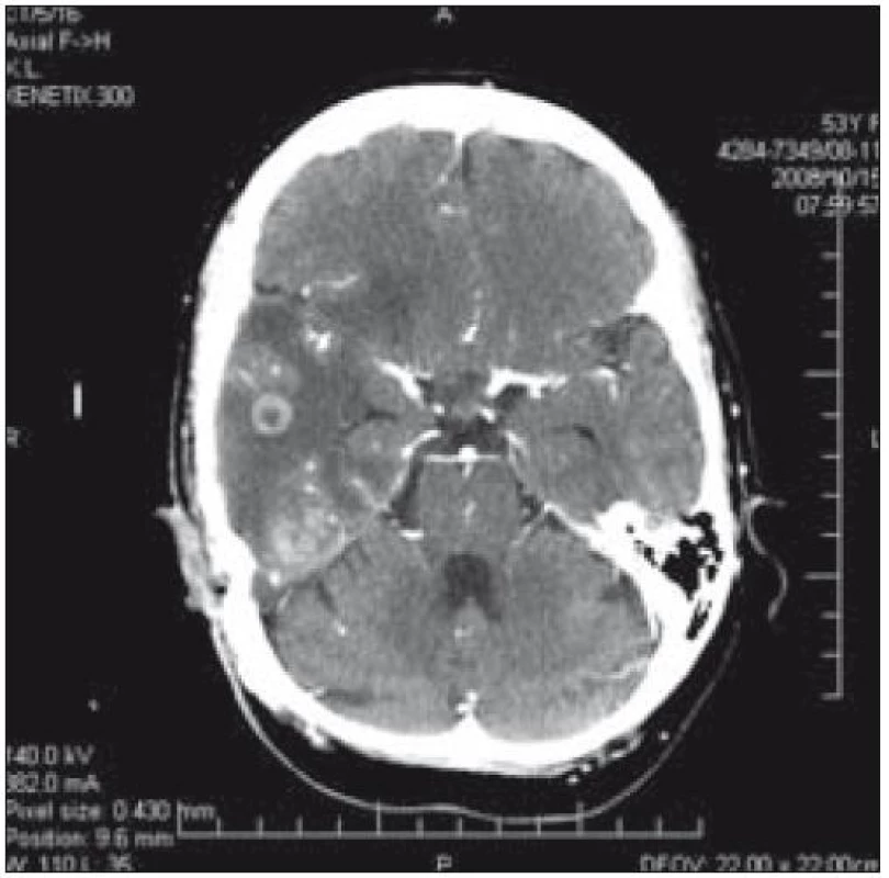 CT mozku – ložiska v temporálním laloku vpravo u pacientky 1.