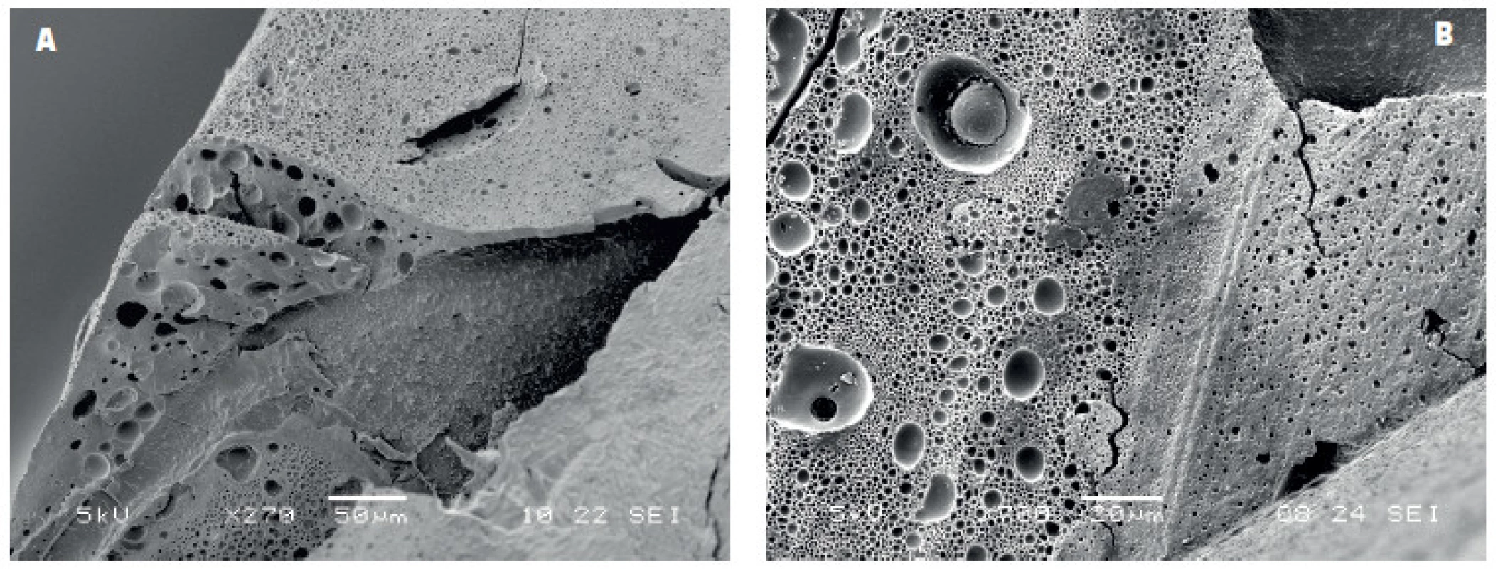 Spodní část kompozitní výplně bondované adhezivem IBO po odstranění skloviny a dentinu demineralizací a deproteinizací pomocí HCl a NaOCl: A) rozsáhlé oblasti porozity ve vrstvě adheziva na spodině výplně v kontaktu s dentinem, B) detail stěny kompozitní výplně s patrnými bublinkami různé velikosti, zvětšení 270 a 700x, SEM