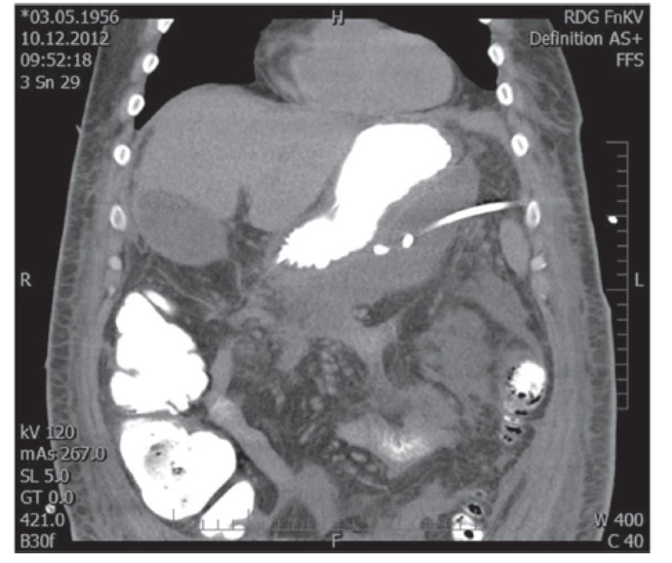 Drén zavedený do kolekce infikované tekutiny vlevo od žaludku
Fig. 1: Drain inserted into the fluid collection left-sided of the stomach