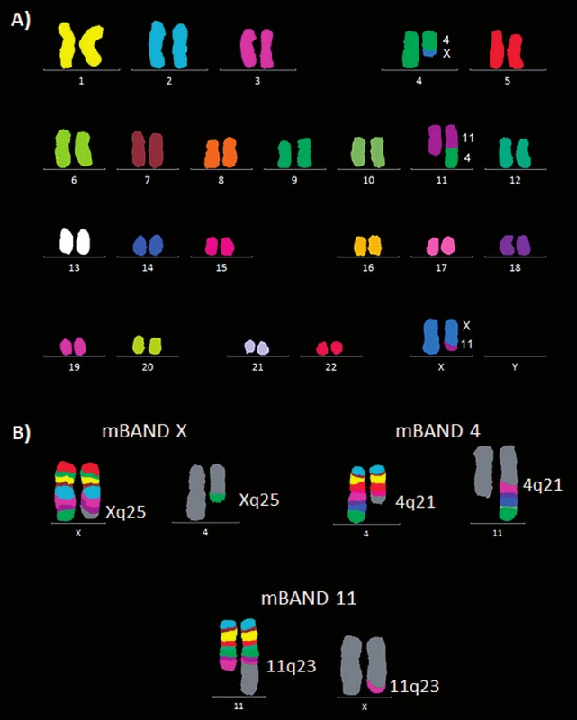 Molekulárně cytogenetická analýza karyotypu pacienta 2. A) Mnohobarevná fluorescenční in situ hybridizace (mFISH). B) Mnohobarevné pruhování s vysokou rozlišovací schopností (mBAND) pro chromozomy X, 4 a 11.