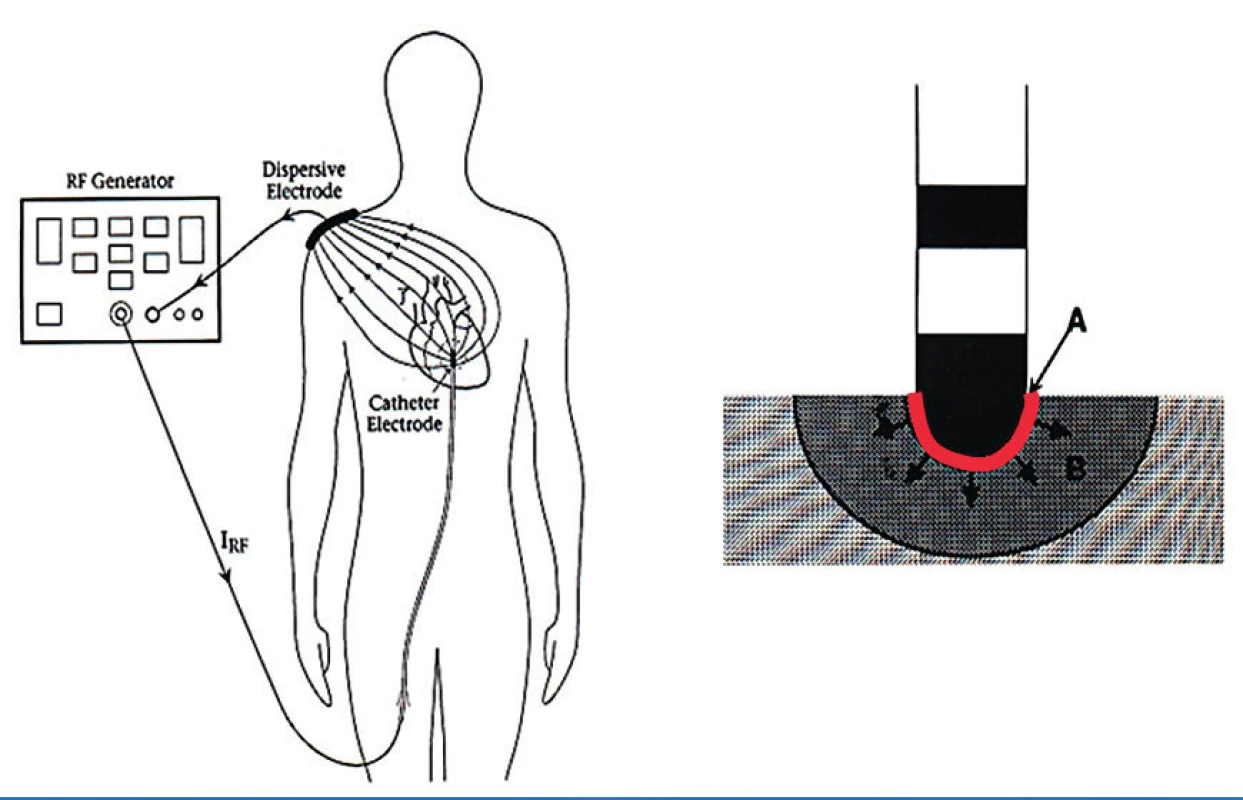 Princip RF katétrové ablace
 RF elektrický proud prochází tkáněmi pacienta mezi hrotem ablačního katétru a plošnou indiferentní elektrodou. V místě kontaktu hrotu ablačního katétru se srdečním endokardem (značeno červenou barvou) je tkáň do určité hloubky díky rezistivnímu ohřevu a kondukci tepla zničena.