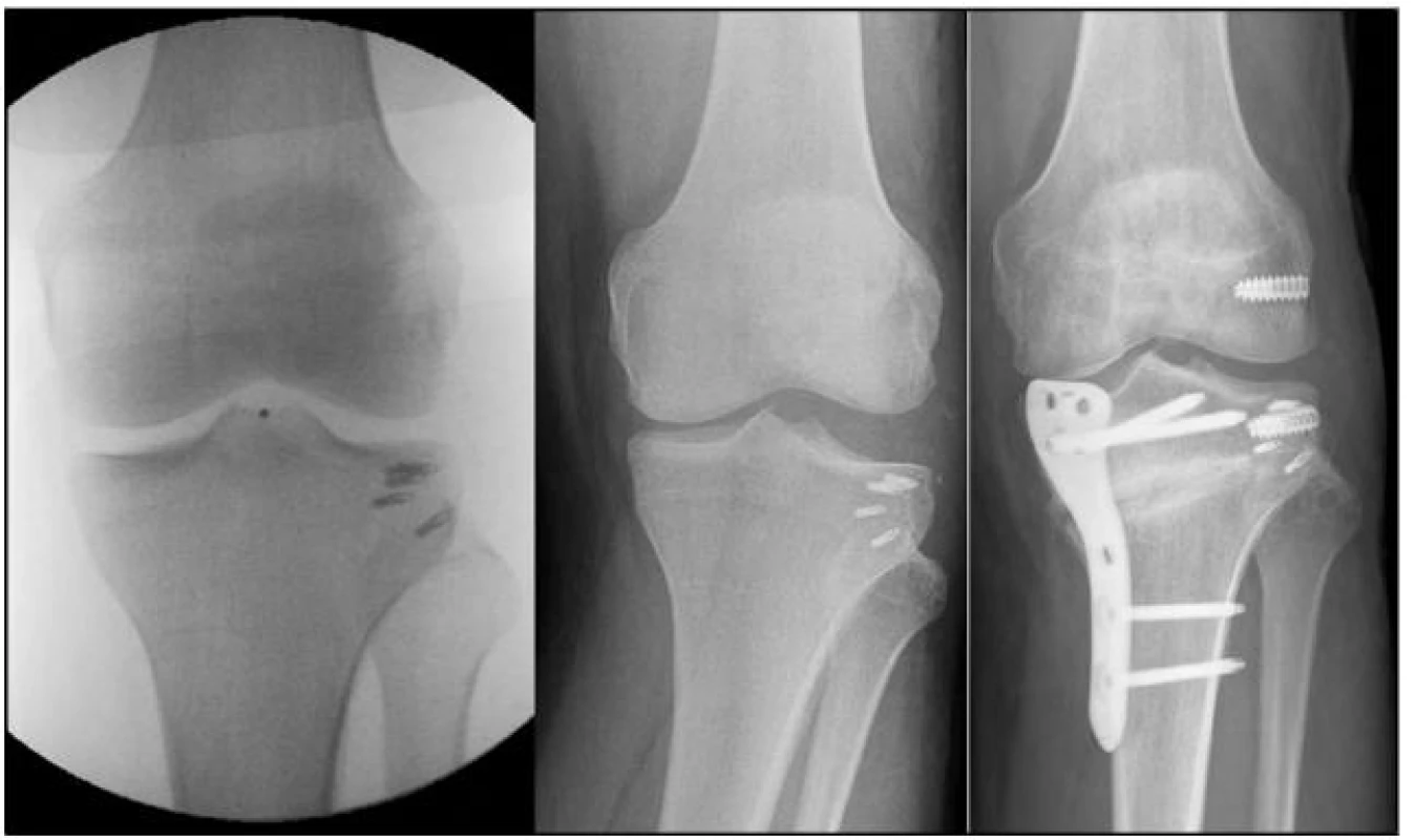 (a) K fixaci TIT, ZPV a kloubního pouzdra byly použité kostní kotvy (b) Rozvoj lat. nestability. (c) Řešeno provedením osteotomie a anatomické rekostrukce