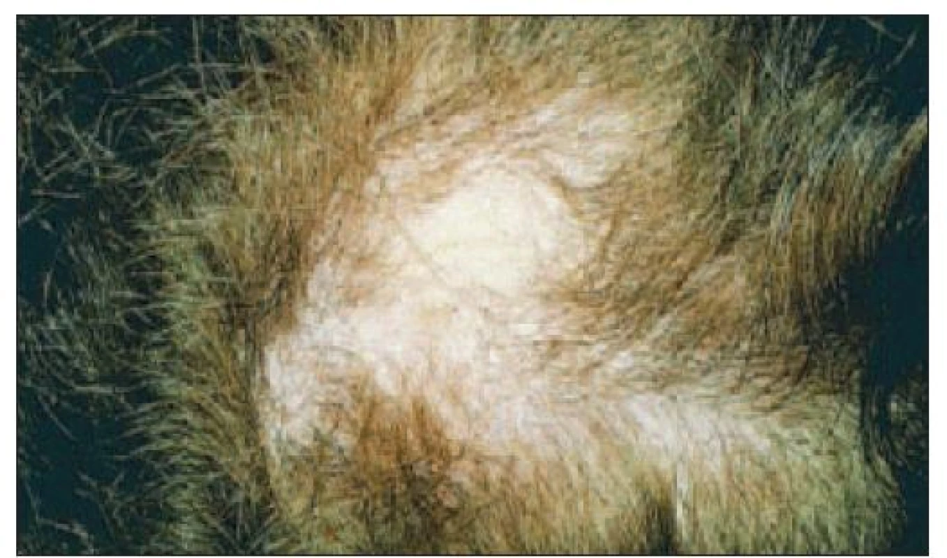 Ložisková alopécia u pacientky s SLE.