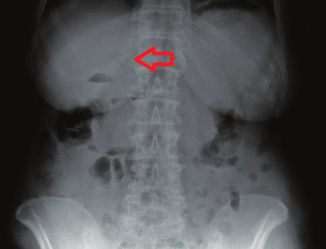RTG břicha – gastrektázie a diskrétní pneumobilie (šipka)
Fig. 1: AXR – gastrectasis and discrete pneumobilia (arrow)