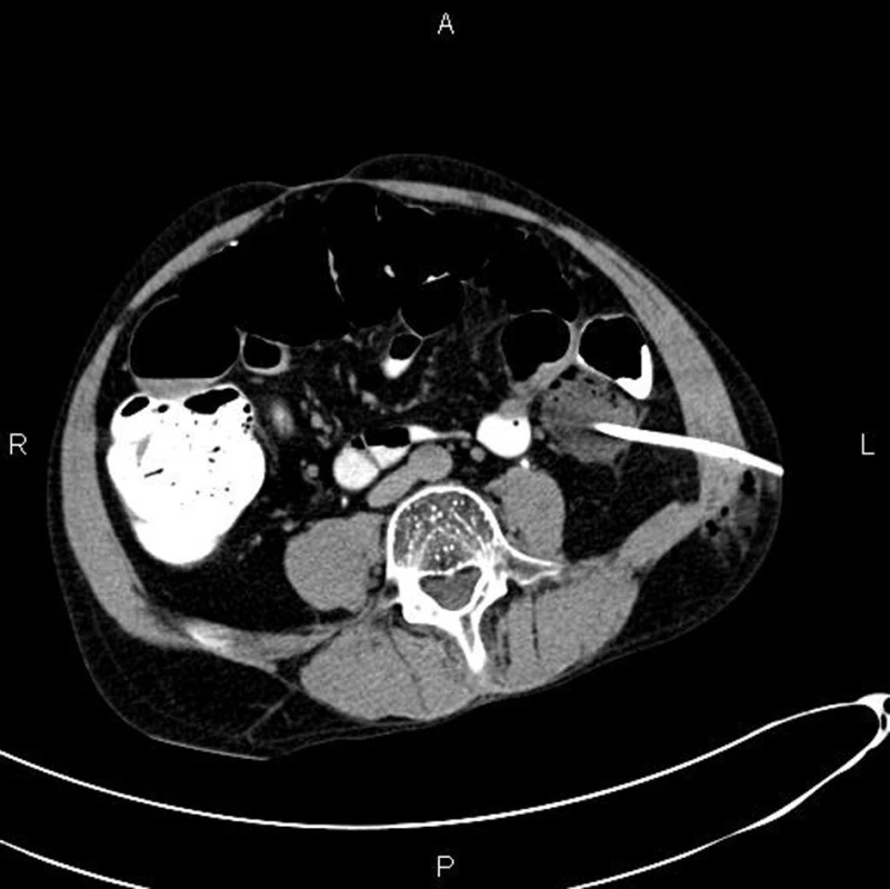 CT vyšetření: perkutánní punkce a drenáž abscesu uloženého dorzálně při colon descendens