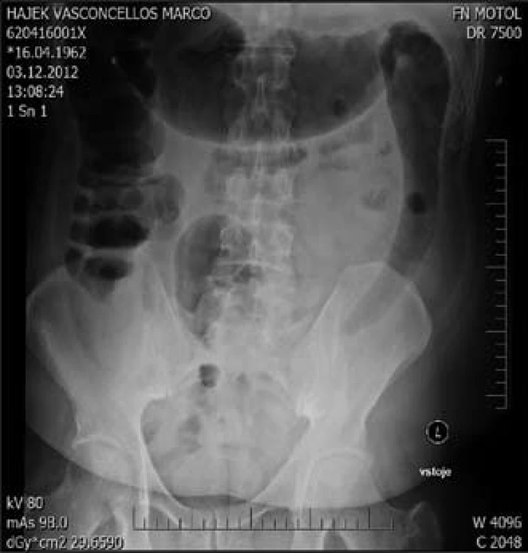 Nativní snímek břicha ve­stoje – megakolon.
Fig. 5. Megacolon (X-rays image).
