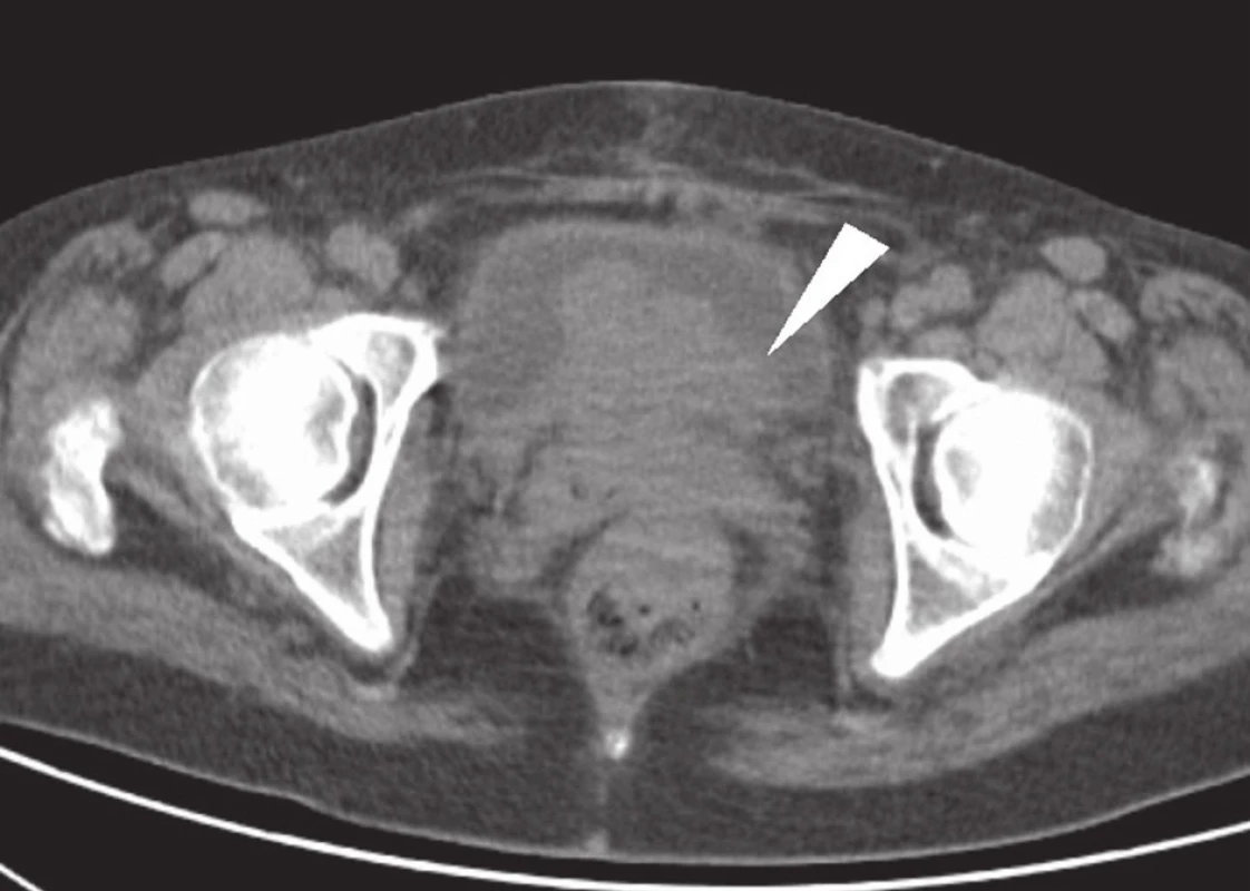 CT vyšetření: rozsáhlý tumor malé pánve, postihující rektum, pochvu a močový měchýř – indikace k totální pelvické exenteraci (bílá šipka).
Fig. 1: CT: large tumour of the small pelvis, invading the rectum, vagina and urinary bladder – indication for total pelvic exenteration (white arrow).