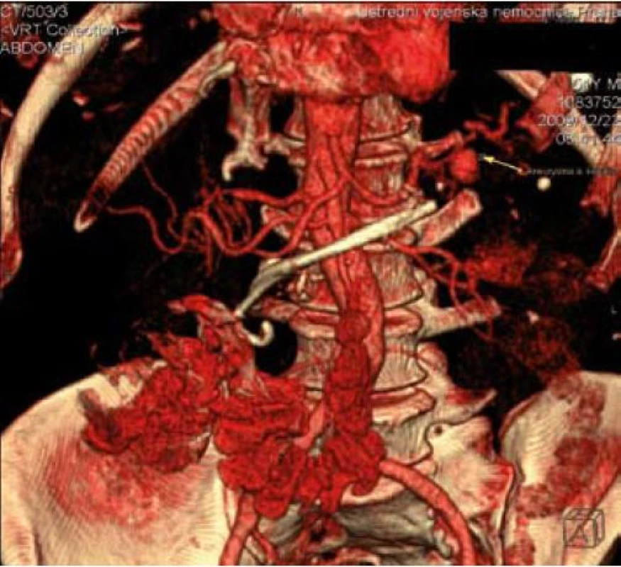 Cevní rekonstrukce s jasně patrným pseudoaneurysmatem lienální arterie o průměru 16 mm. Stenty v ductus Wirsungi před aortou.
Fig. 1. Vascular reconstruction – splenic artery pseudoaneurysm – diameter 16 mm. A pancreatic duct stent in front of the aorta.