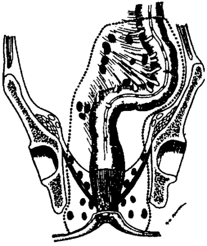 Schéma rozsahu operace
Fig. 2. Figure showing the extent of rectal excision