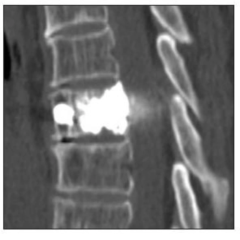 CT hrudní páteře, sagitální rekonstrukce po vertebroplastice obratle Th7
Fig. 4. Thoracic spine CT, sagittal reconstruction following TH7 vertebroplasty