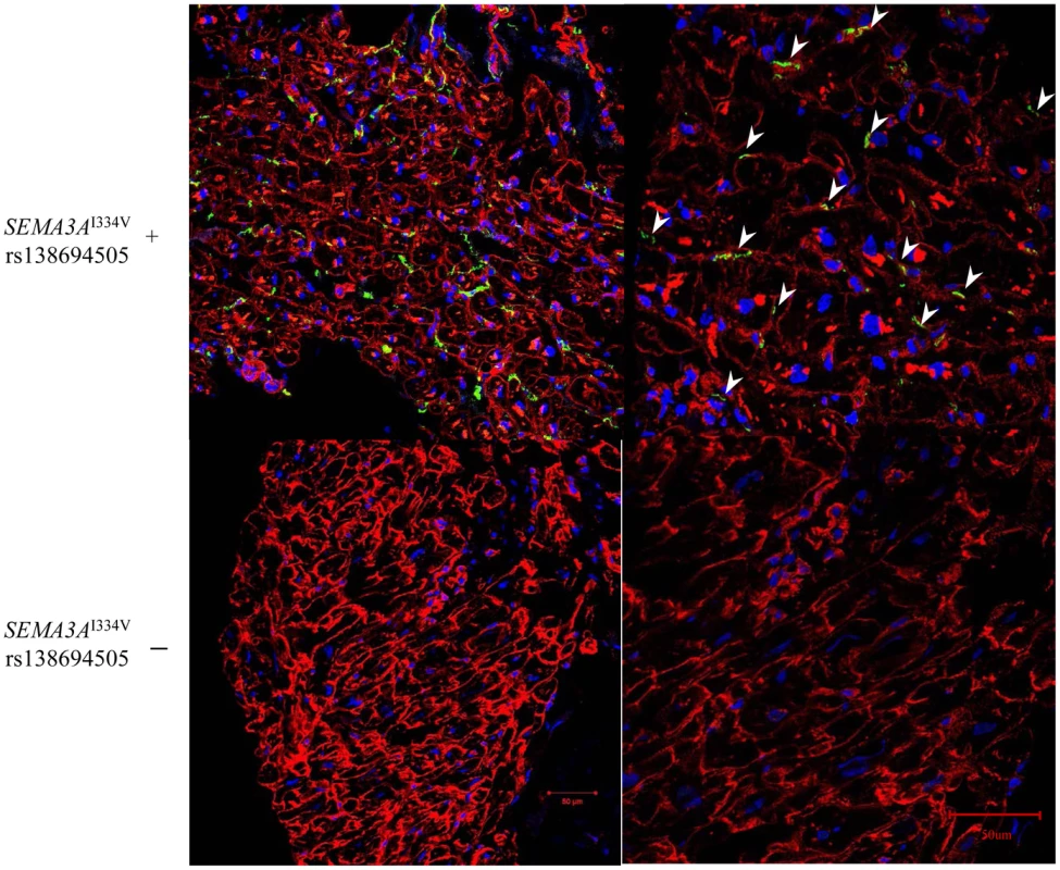 Immunofluorescence staining for Vinculin and anti-TH in the subendocardial layer of patients with and without <i>SEMA3A</i><sup>I334V</sup>.
