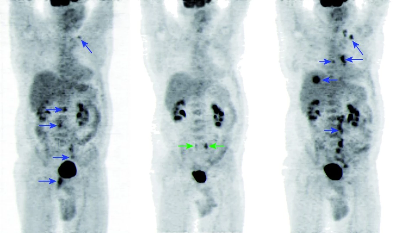 18F-FDG PET sken, MIP (maximum intensity projections).
A. před zahájením léčby, B. v jejím průběhu, C. při progresi onemocnění.
A. Ložiska vyšší konzumpce glukózy (modré šipky) v levém nadklíčku, retroperitoneálních uzlinách, ilických uzlinách vlevo a v pánvi retrovesikálně odpovídající primárně tumoru rekta.
B. Vymizení výše popsaných ložisek hypermetabolizmu glukózy, tj. dosažení PET kompletní remise, po 4 sériích léčby. Oboustranně zachycena vřeténka aktivní moči v ureterech – odpovídající vylučování radiofarmaka močí (zelené šipky). C. Znovu se zobrazují ložiska patologického hypermetabolizmu glukózy (modré šipky) po 13 měsících od zahájení léčby, a to ve více uzlinách levého nadklíčku, v mediastinu a levém plicním hilu, seg. VIII. pravého laloku jater a ve více uzlinách retroperitone a vlevo a levostranných ilických uzlinách.