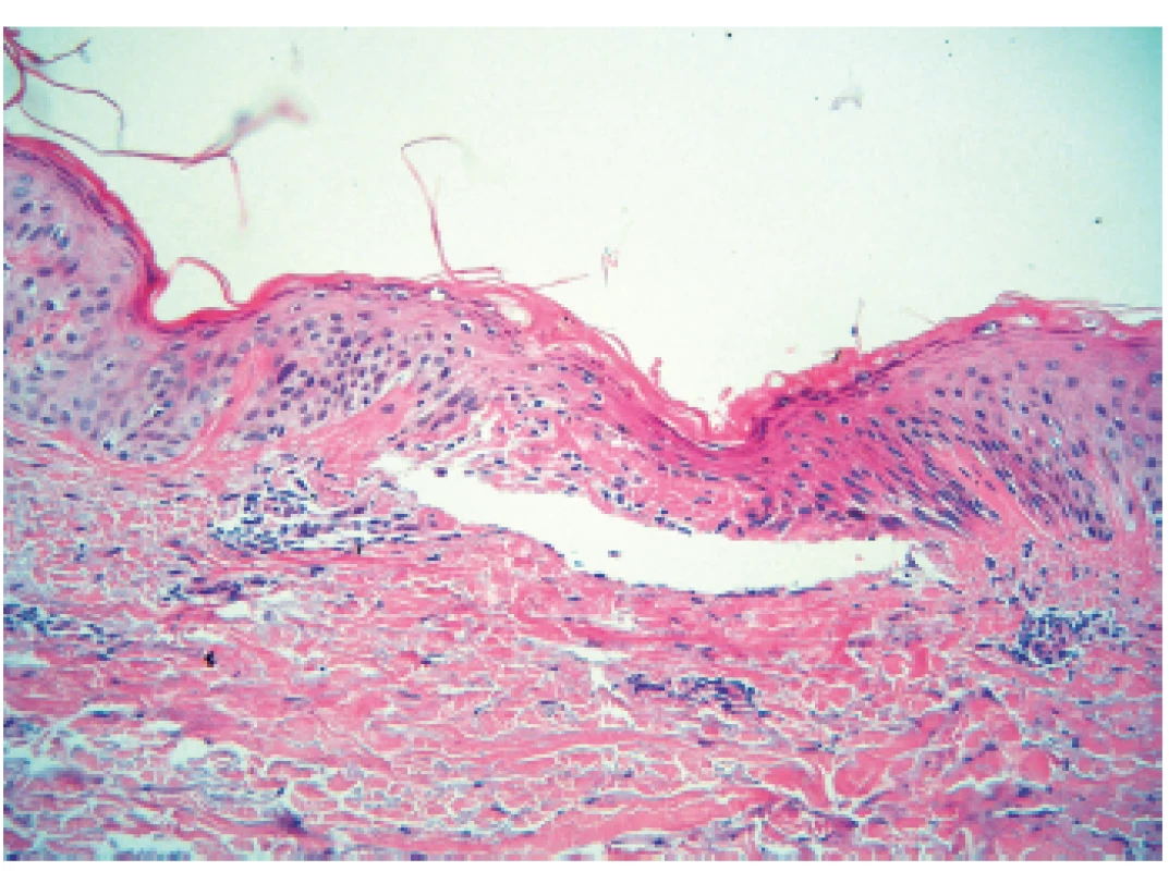 Suprabazální akantolytická vezikula, spongióza, diskrétní dyskeratóza – obraz blízký morbus Grover