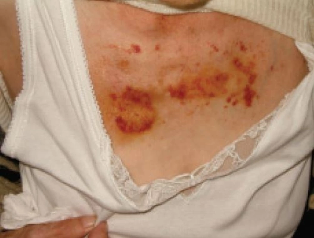 Krvácení do kůže při AL amyloidóze.