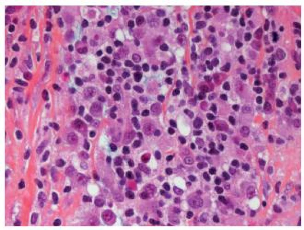 Obscuring inflammation in lymphoepithelioma-like carcinoma; the epithelial cells are not easily recognizable.
