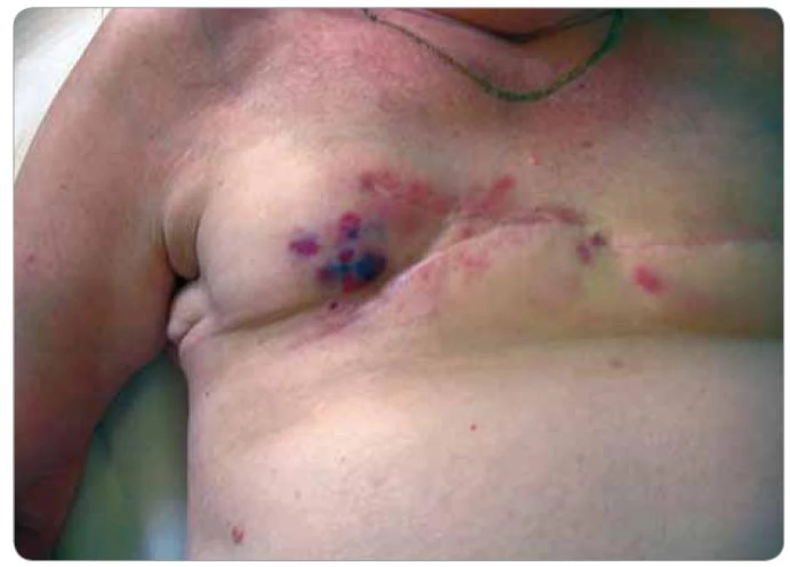 Lividní lentikuly ve střední části jizvy, které se objevily 6 měsíců od vzniku kožních infiltrátů na obr. 3 (pacient č. 1).