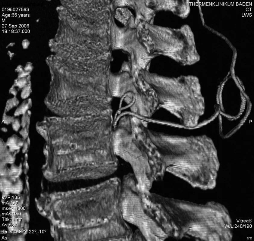 3D zobrazení polohy epidurálního katétru mezi L2–3, pohled z levé strany