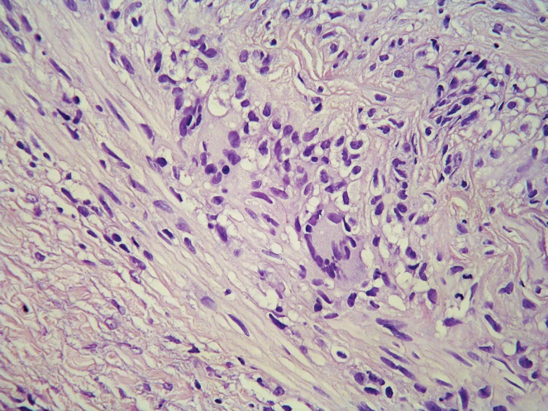 Lymfocyty a několik obrovských mnohojaderných buněk Langhansova typu ve svalovině tepny
