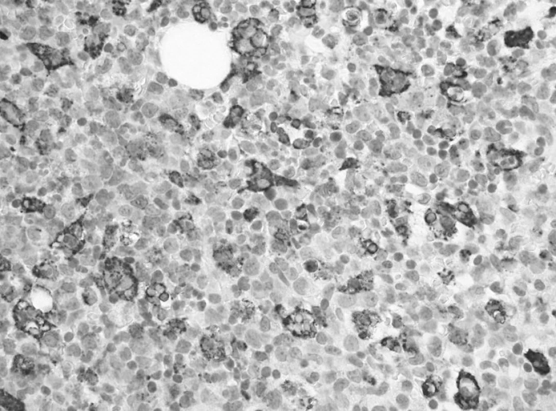 Prvé trepanobioptické vyšetrenie: výrazná hemofagocytóza v makrofágoch drene označených imunohistochemickou reakciou na dôkaz CD68 (60x).
Fig. 2. First trepanobioptic examination: a marked hemophagocytosis in macrophages of bone marrow marked by immunohistochemical reaction for the demonstration of CD68 (60x).