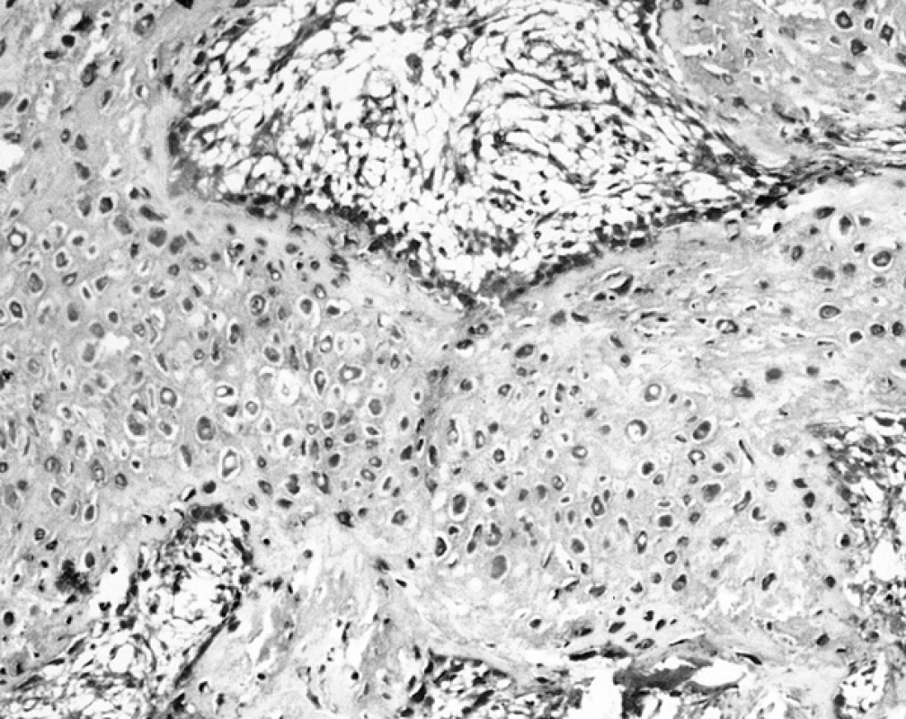 Pozitivní osteoblasty na povrchu trámečku a perzistující chondrocyty uvnitř trámce v reakci k průkazu S-100 A6 (120krát)
