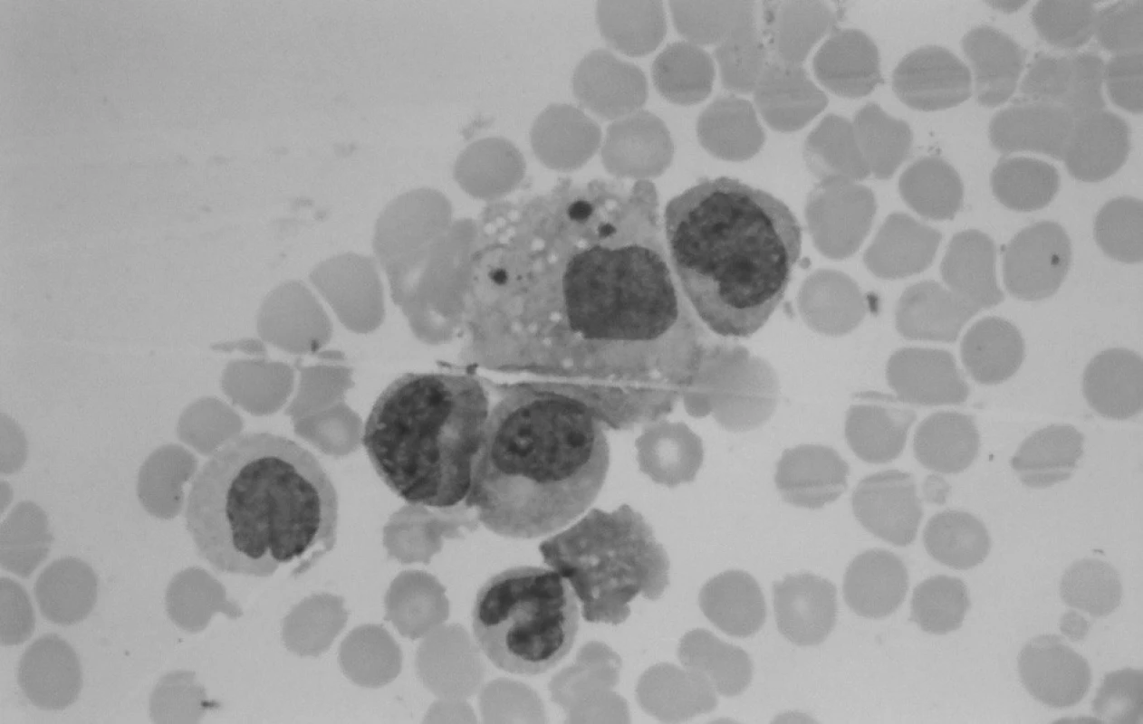 Punkcia kostnej drene: makrofág s fagocytovanými trombocytmi.
Fig. 3. Puncture of bone marrow: macrophage with phagocytosis of thrombocytes.