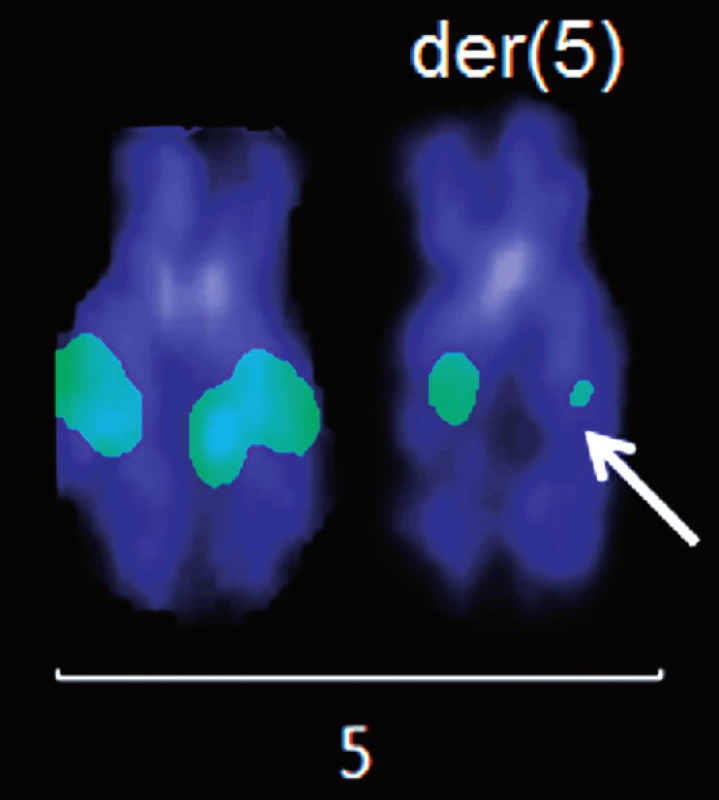 Analýza pomocí fluorescenčně značených BAC klonů. Hybridizace BAC klonu RP11-461G12 pro chromozom 5q15. Šipka označuje signál o nápadně slabší intenzitě.