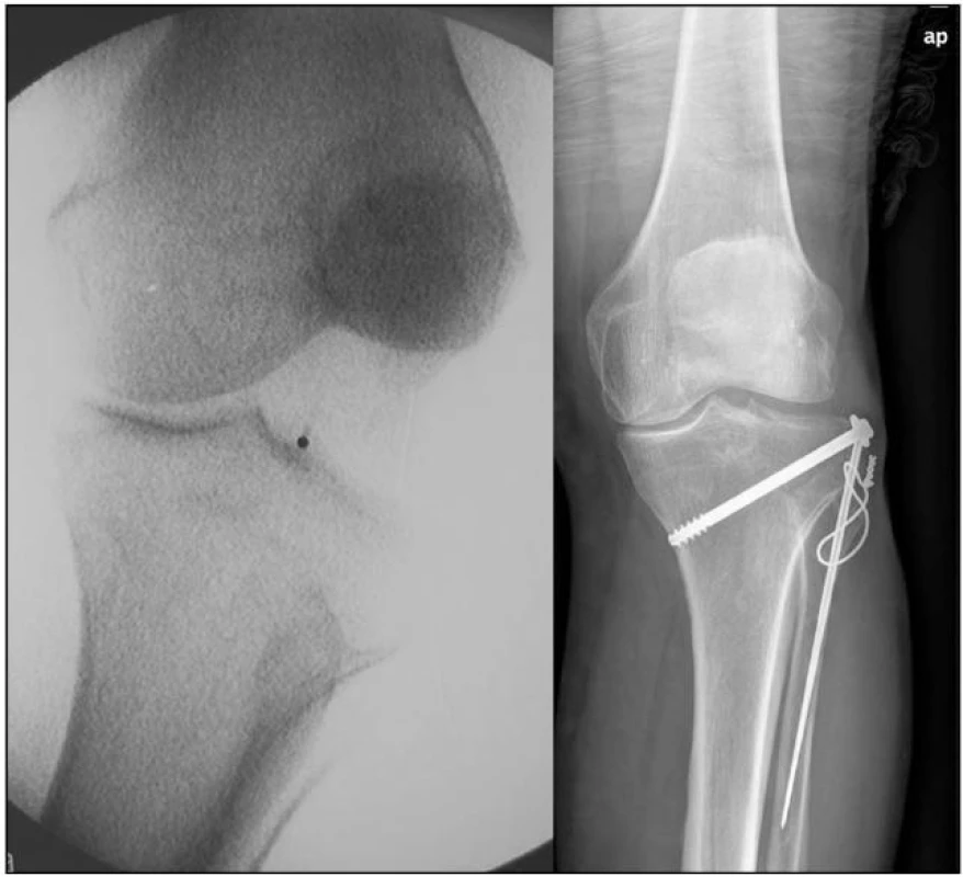 (a) Držený snímek - přítomost abrupce fibuly, tuberculum Gerdi, Segond. zlomenina a ruptura PZV (b)
Stav po osteosyntéze
