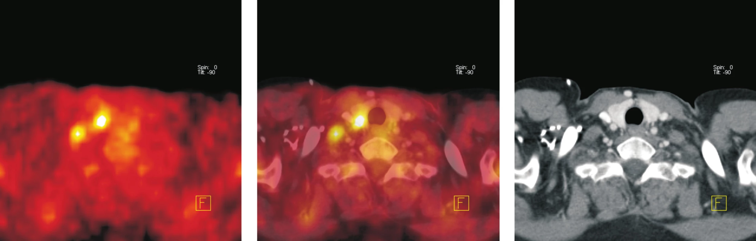 Transverzální tomografické řezy v úrovni štítné žlázy (a - PET, b - fúze PET/CT, c – CT). Ložisko zvýšené akumulace &lt;sup&gt;18&lt;/sup&gt;F-FDG v pravém laloku štítné žlázy velikosti 10 x 10 mm, na CT má nehomogenní strukturu. Opakovanou aspirační cytologií, laboratorním vyšetření, klinickým a ultrazvukovým sledováním prokázána koloidní struma bez poruchy funkce. Při kontrolním vyšetření o 12 měsíců později nebyla zvýšená akumulace &lt;sup&gt;18&lt;/sup&gt;F-FDG patrná.