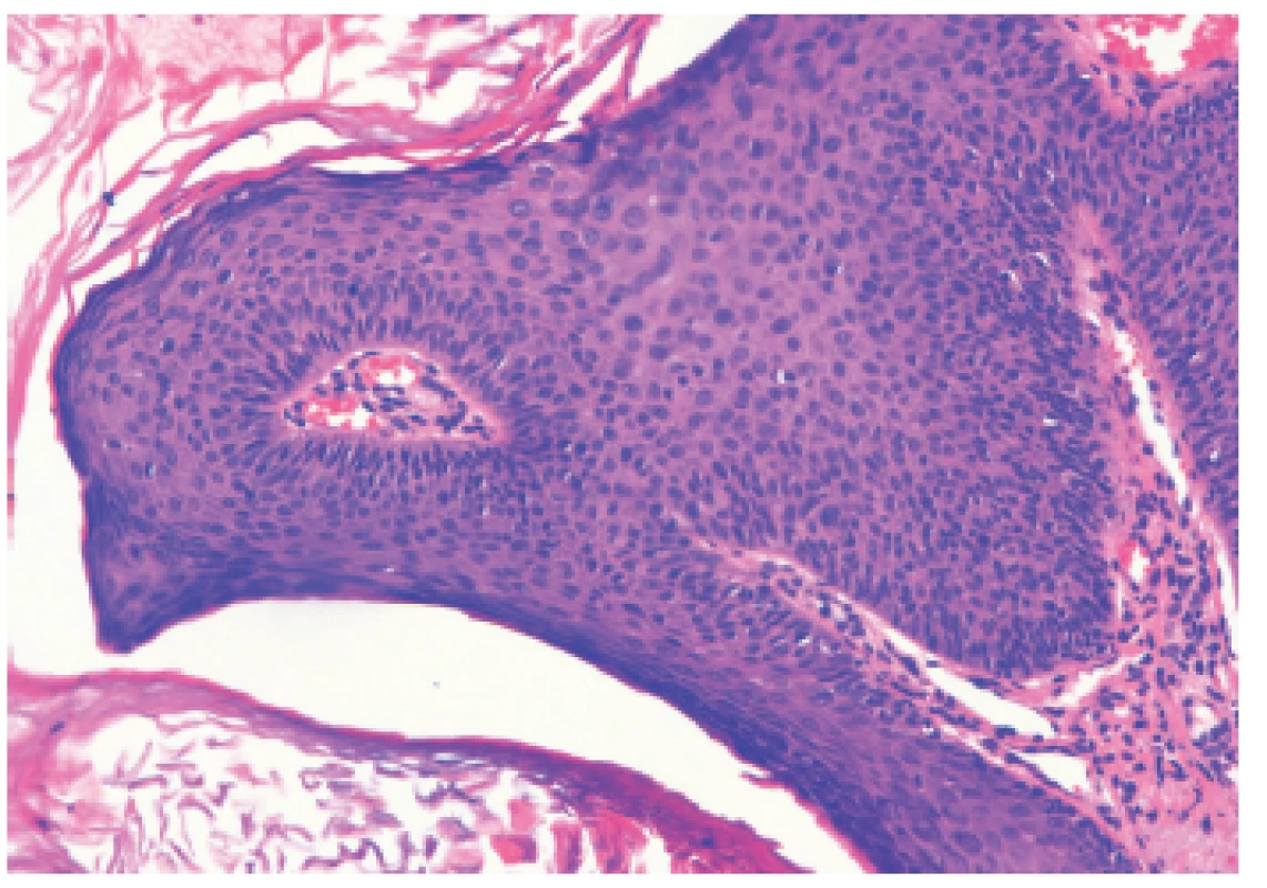 Histologický nález z lézie (HE 100x)
Priečny prierez vulgárnej veruky histomorfologicky pripomínajúcej kožný papilóm s hyperplastickým pravidelným dlaždicovým epitelom s hyperkeratózou s parakeratózou. V stróme je vyznačená papilomatóza mierneho stupňa s lymfocytovou infiltráciou, najmä perivaskulárne.