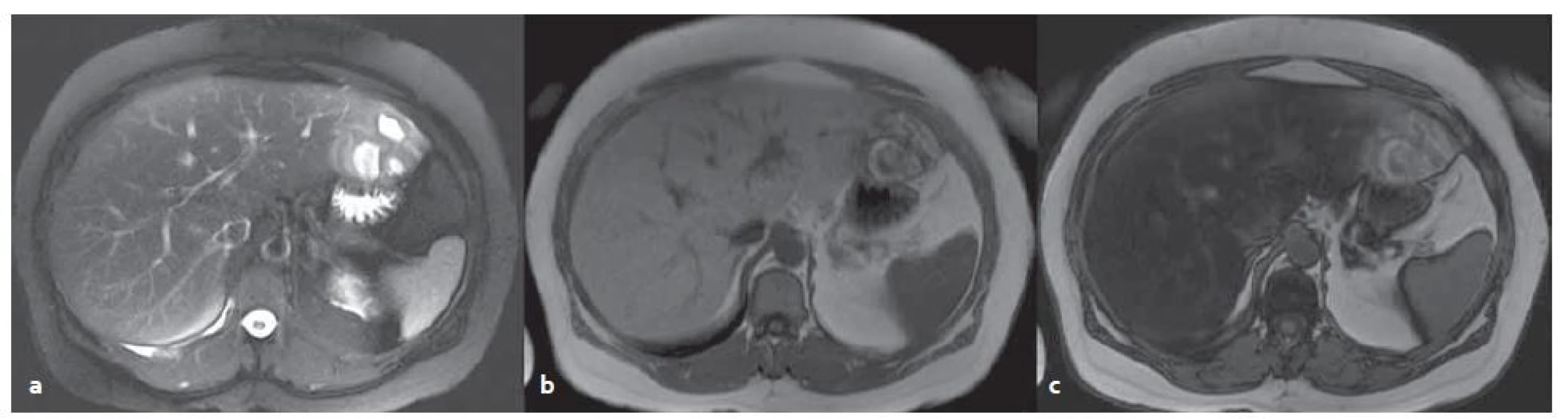 MR vyšetření – blíže nespecifikovaný adenom v levém laloku s okrsky nekróz a krvácení v terénu steatózy. T2W tra haste 2D trig bez potlačení tuku (a), v T1W ge 2D in (b), opp (c) – dobře patrná změna signálu jater při steatóze.
Fig. 6. MR examination – unclassified adenoma in the left lobe of steatotic liver with necrosis and bleeding. T2W tra haste 2D trig without fat suppression (a) in TW1 ge 2D in (b), opp (c) – change of the signal in steatosis is evident.