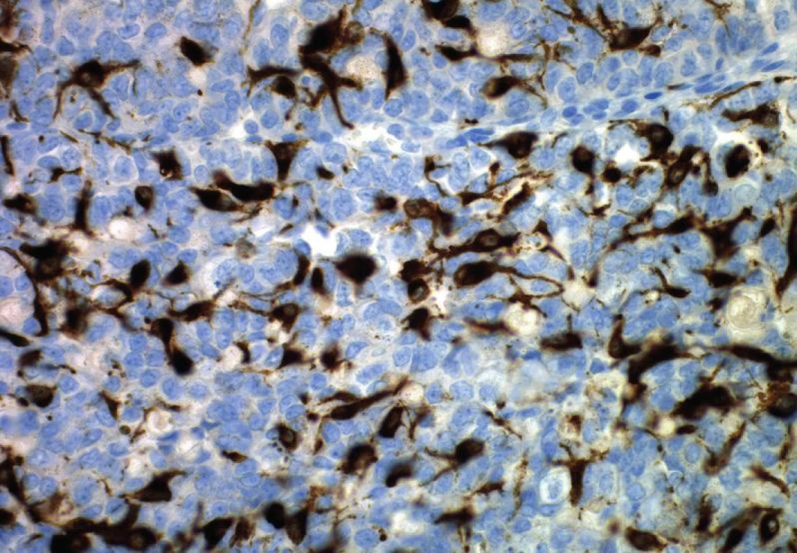 Dendritické melanocyty exprimující melan A mezi negativními matrikálními buňkami (původní zvětšení 400x).