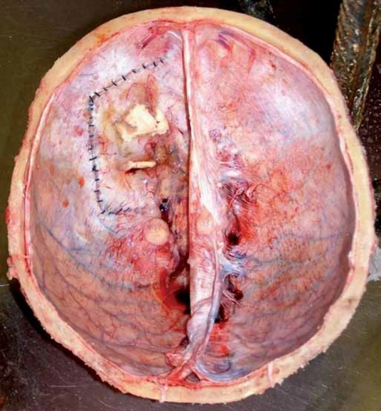 Pohled do kalvy pokryté tvrdou plenou, kde je patrná recidiva tumoru na tvrdé pleně a sutura tvrdé pleny po operačním zákroku (pitevní fotografie).