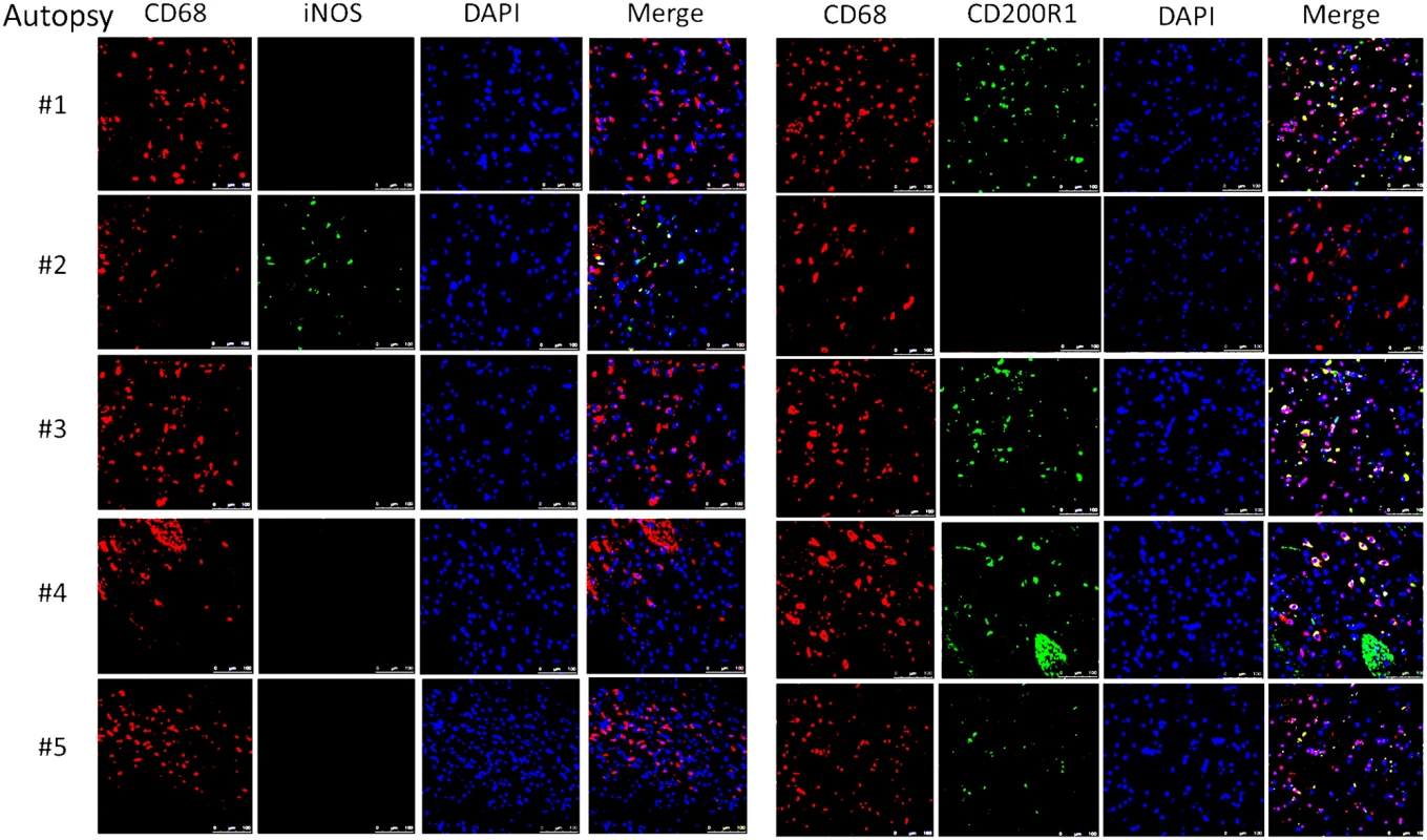 Brain immunofluorescence of autopsy specimens from patients who died of s-CNS cryptococcosis demonstrates macrophage and T-cell tissue infiltration.