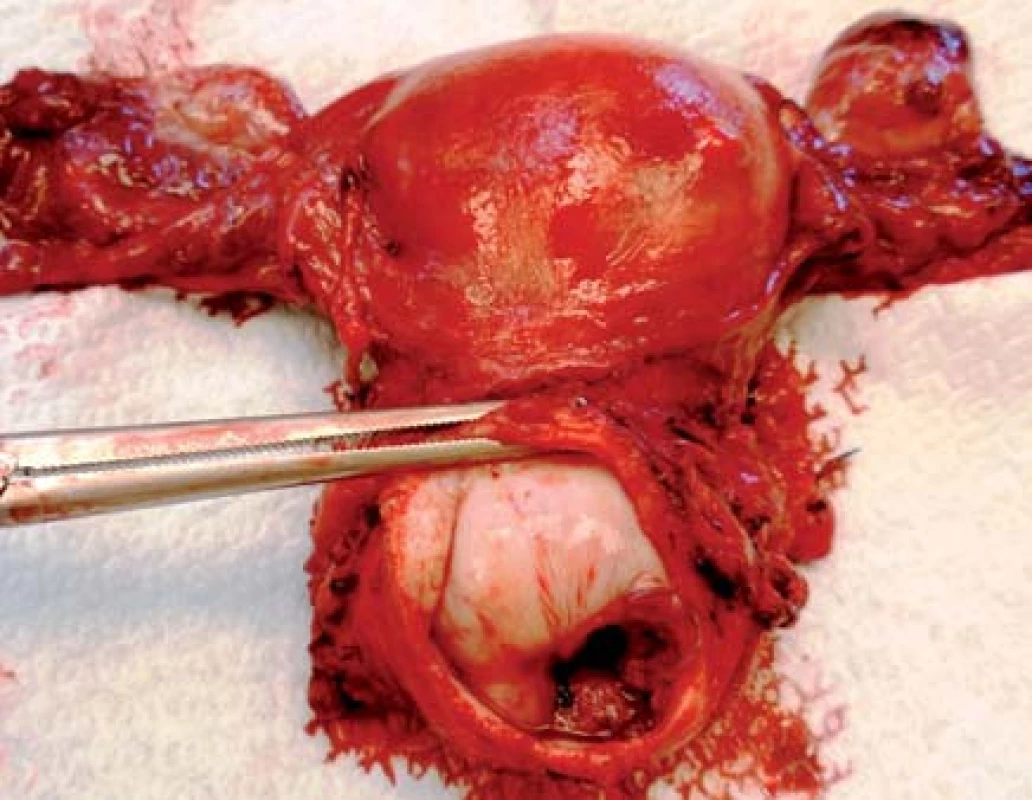 Preparát dělohy s karcinomem děložního hrdla stadia IB (foto Masarykův onkologický ústav)