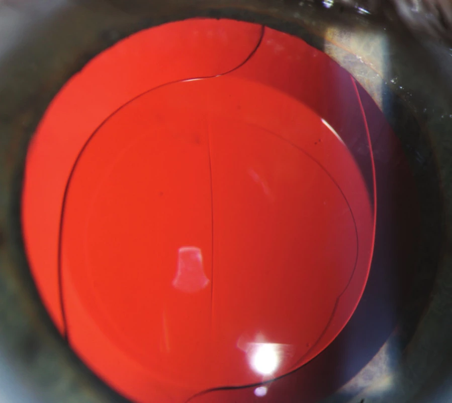 Hanita B lens hydrofilní akrylát. Stejný pacient jako na obr.3 – čištěné celé pouzdro (33 měsíců od operace) – bez přítomnosti ACO i PCO.