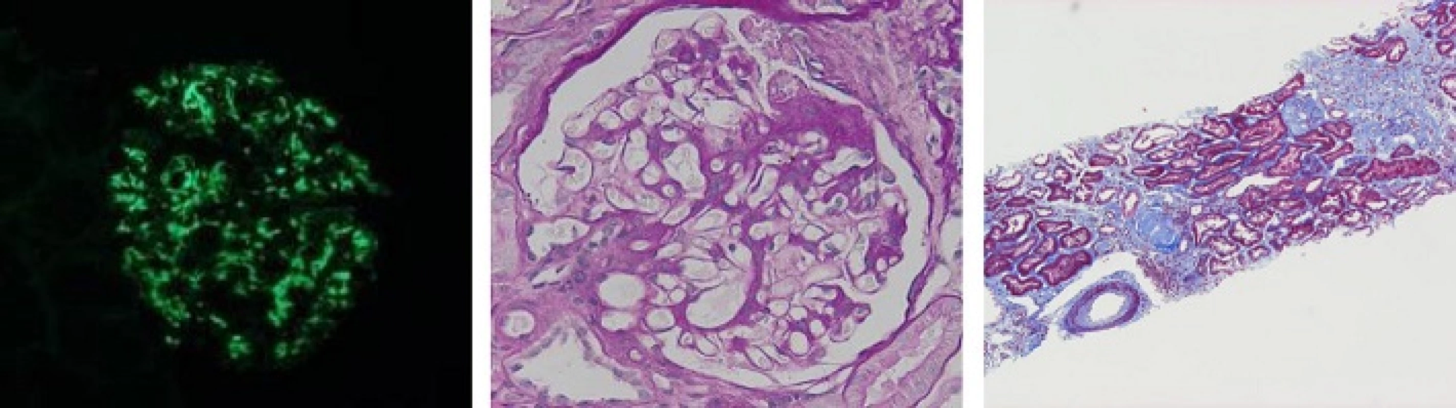 Histological findings of the renal tissues. a IgA, (b) Mesangial matrix expansion and fibrocellular crescent formations were observed in glomeruli with periodic acid-Schiff (PAS) staining (400×). c Slight changes of interstitial fibrosis and arteriole sclerosis with Masson staining (40×)