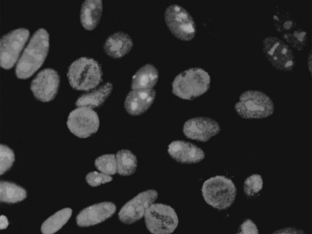 Anti-Pm-Scl produkují homogenní jadérkovou fluorescenci
na Hep-2 buňkách při nepřímé imunofluorescenci.
Mírnou jemně granulární fluorescenci vykazuje také jádro.
V dělících se buňkách jsou v metafázi chromozomy negativní
a nebarví se ani NOR (nucleolar organising region), na rozdíl
chomáčkovité nebo skvrnité nukleolární fluorescence způsobené
protilátkami proti fibrilarinu či RNA polymeráze, kde bývají
další doprovodné změny v dělících se buňkách.
Obr. 3. Reaktivita na PM1-α (a) a na PM-Scl-100 (b) u pacientů
s polymyositidou (PM), systémovou sklerózou (Scl)
a s překryvným syndromem PM/Scl (data převzata z (6, 17)).
revma 4 zlom 14.1.2010 9:25 Str. 202
