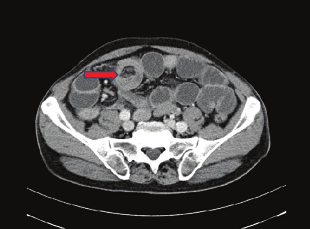 CT břicha − nativně a postkontrastně: v oblasti malé pánve patrné solidní ložisko velikosti 67x63x58mm− jde s velkou pravděpodobností o TU colon sigmoideum. Divertikulosa orálního sigmoidea.
Fig. 2: Nonenhanced and contrast-enhanced abdominal CT scan: a solid mass measuring 67x63x58 mm located in the lesser pelvis – very probably an image of a sigmoid colon tumor. Diverticulosis of the proximal sigmoid colon.